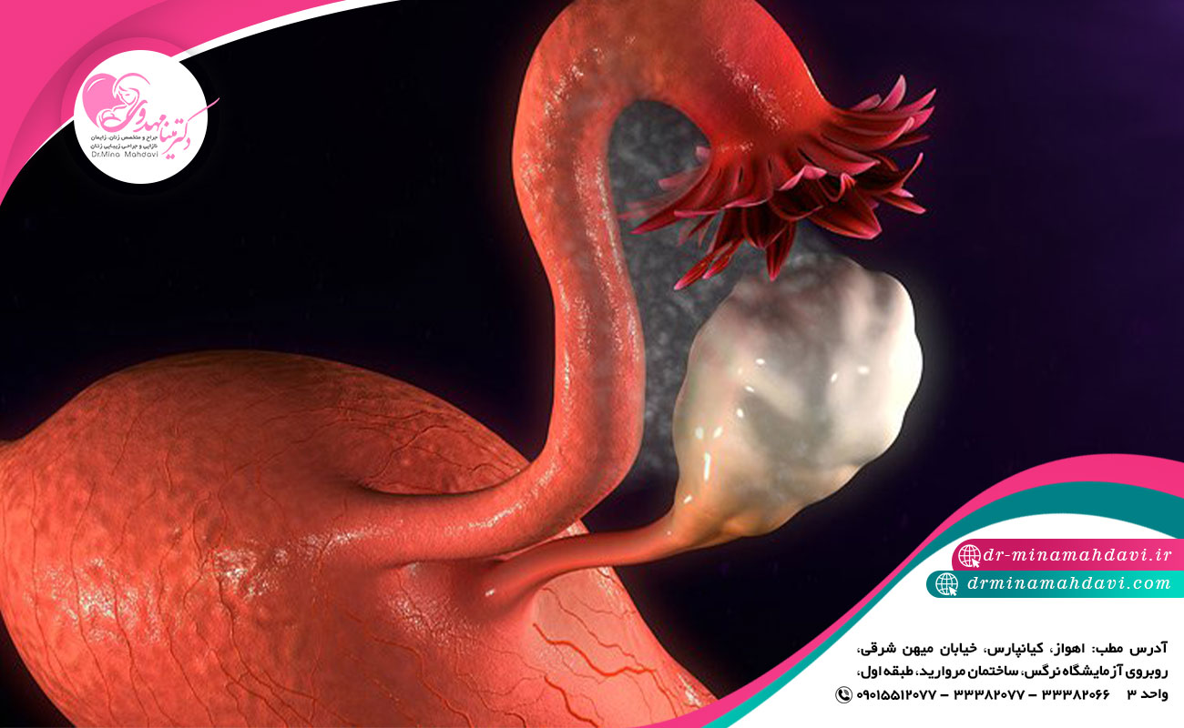 آندومتریوز چیست ؟