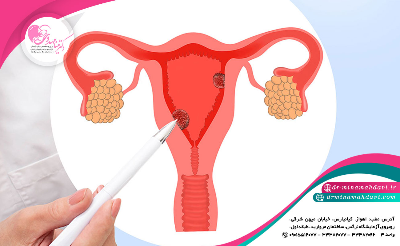 نظارت و انتظار بعد از به وجود آمدن پولیپ رحمی چگونه است؟
