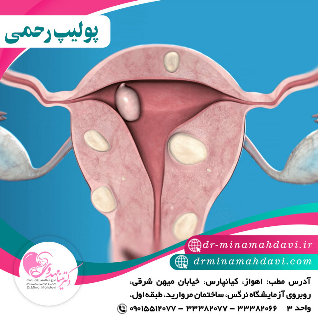 پولیپ رحمی