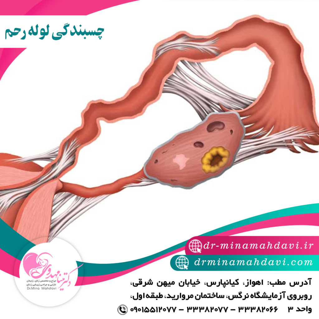 علل ایجاد چسبندگی لوله رحم