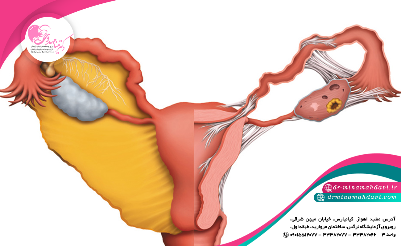 پیشگیری و درمان چسبندگی لوله