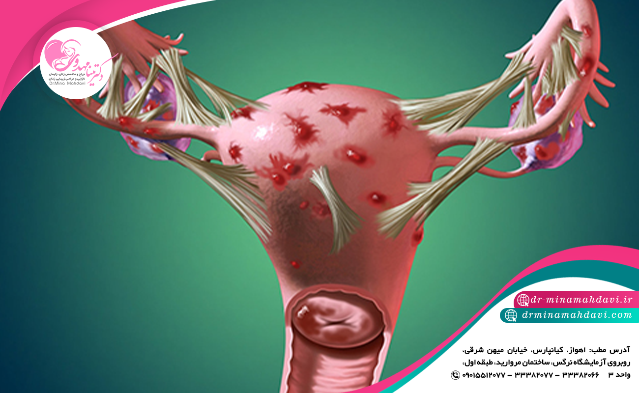 اختلالات ناشی از چسبندگی لوله
