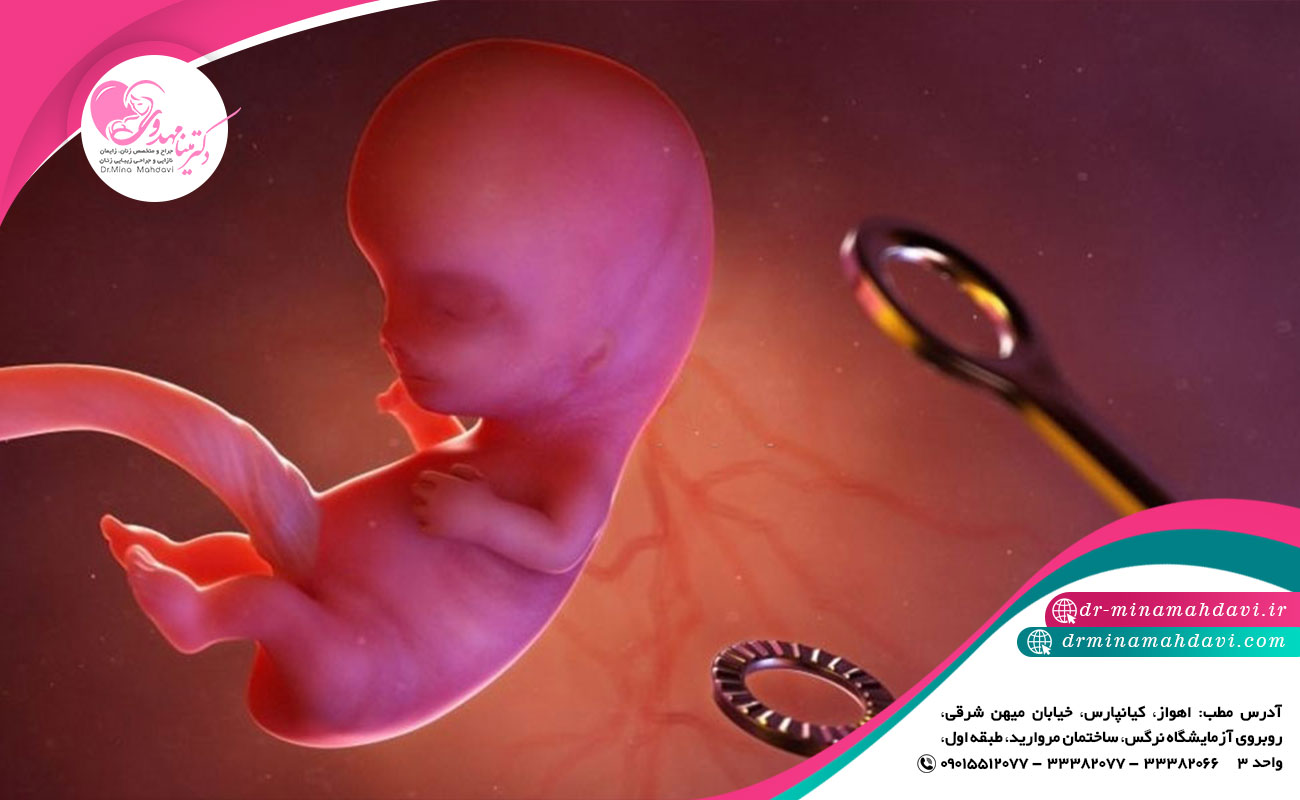  عوامل موثر بر سقط جنین