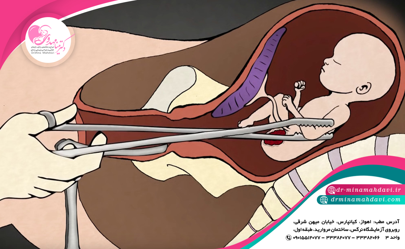 بررسی خطرات و عواقب کورتاژ جنین