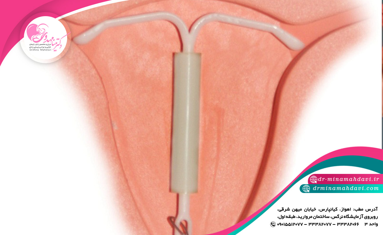 آیا افرادی که در دوره شیردهی هستند می توانند از آی یو دی استفاده کنند؟