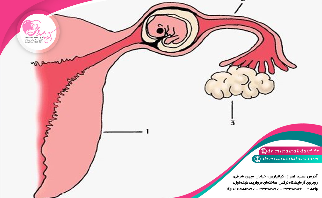 راه‌ های تشخیص حاملگی خارج رحم