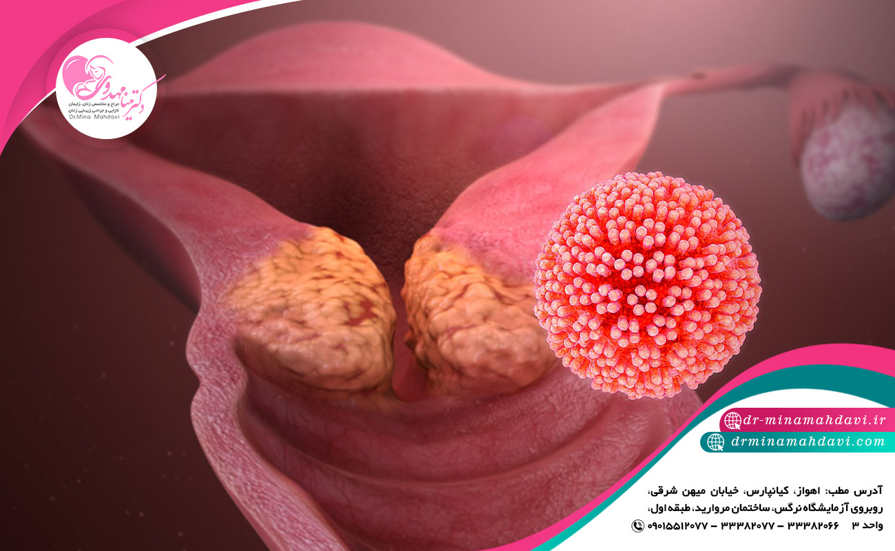 زگیل تناسلی چه موقع خطرناک است؟