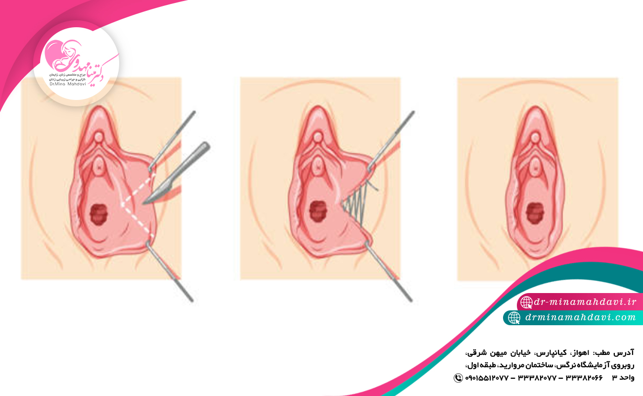 ارتباط لابیاپلاستی با بارداری و زایمان طبیعی
