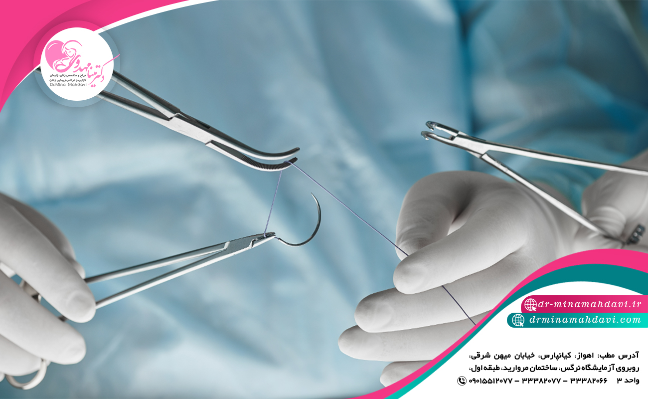 مراقبت از بخیه ها بعد از لابیاپلاستی