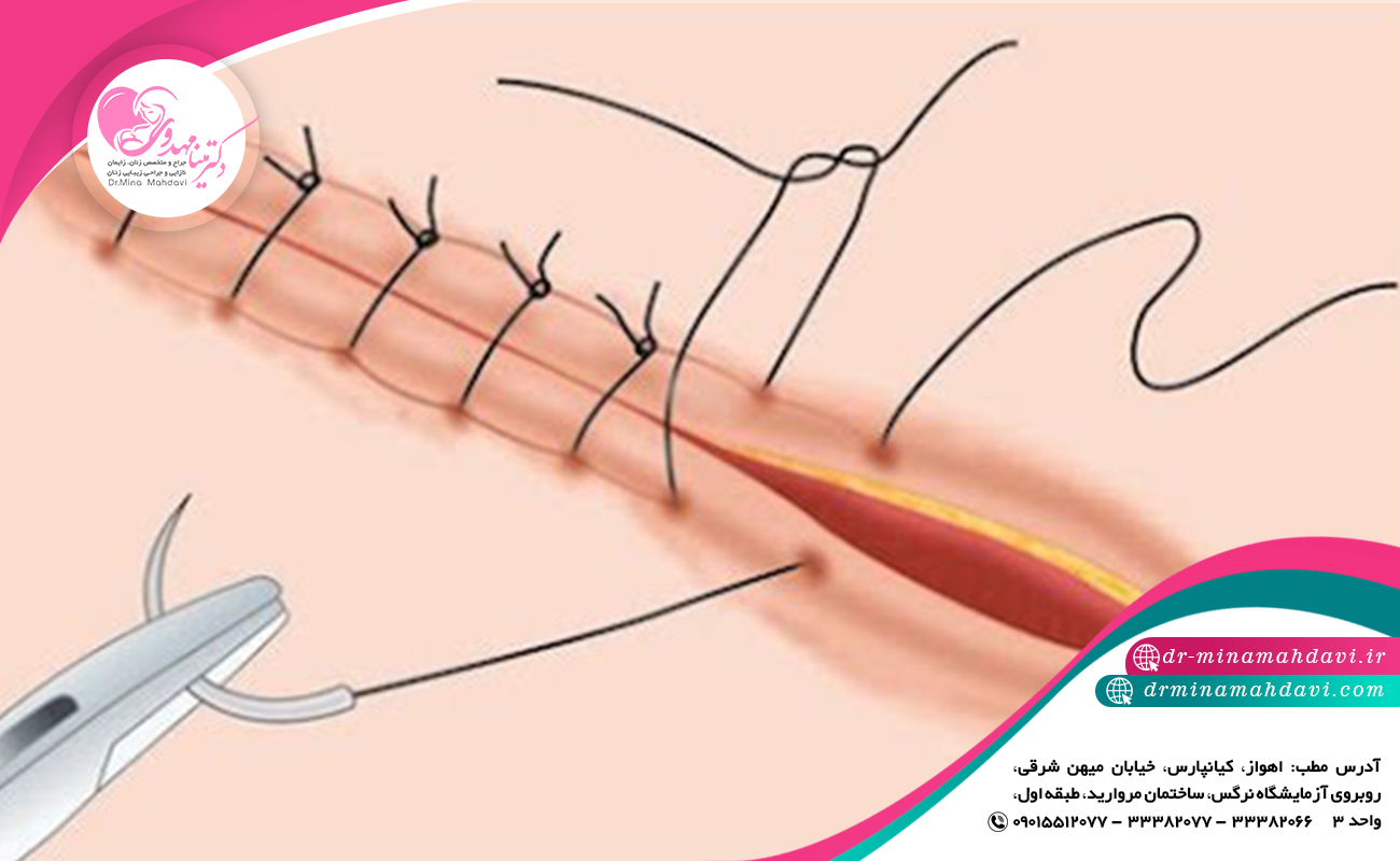 نکات تکمیلی در مورد بخیه بعد از لابیاپلاستی