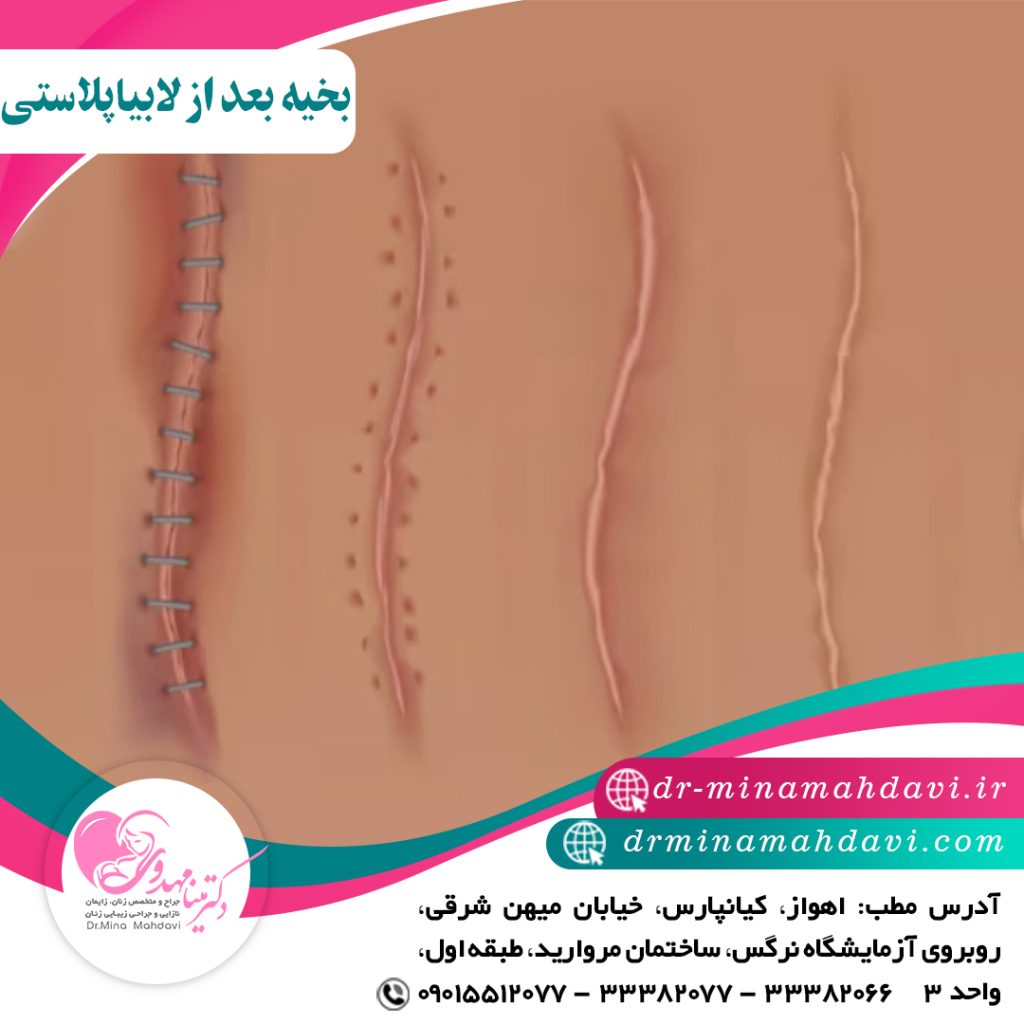بخیه بعد از لابیاپلاستی