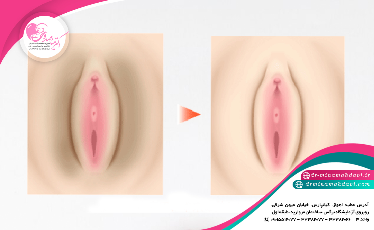 علت های تیرگی واژن