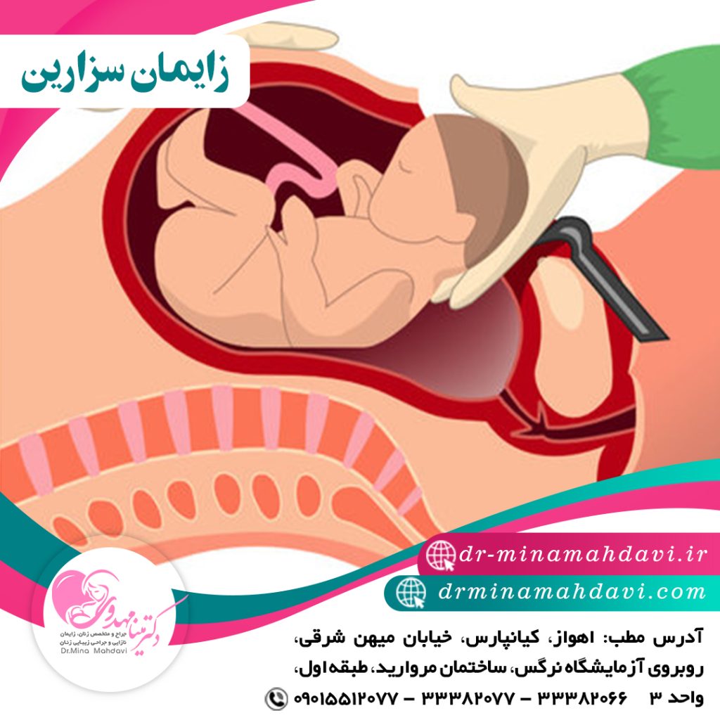 زایمان سزارین چقدر طول می کشد؟