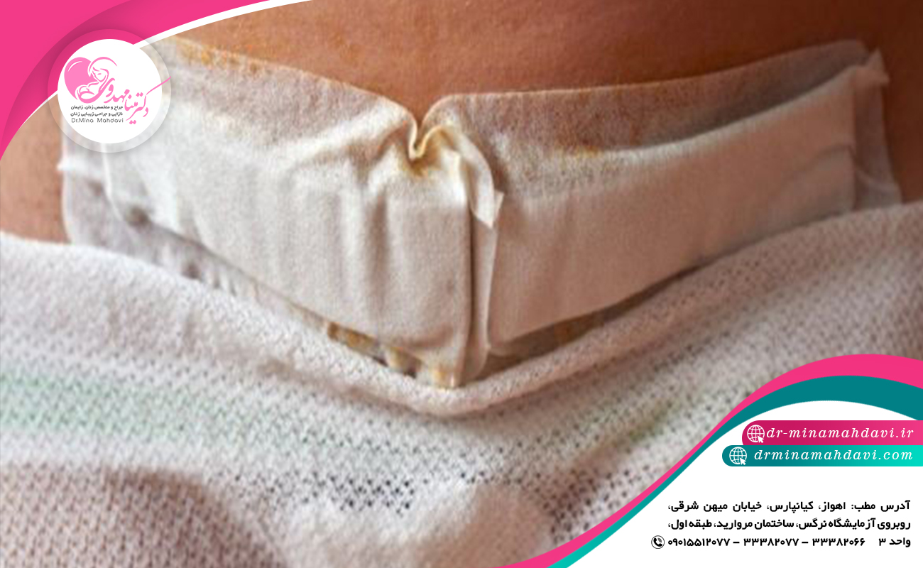 چسب ضد آب بعد از سزارین