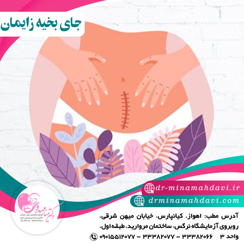 جای بخیه زایمان سزارین