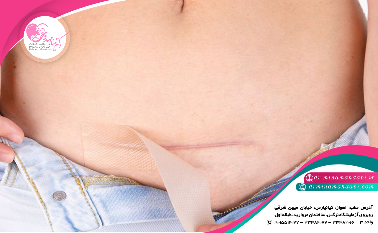 علائم عفونت بخیه سزارین