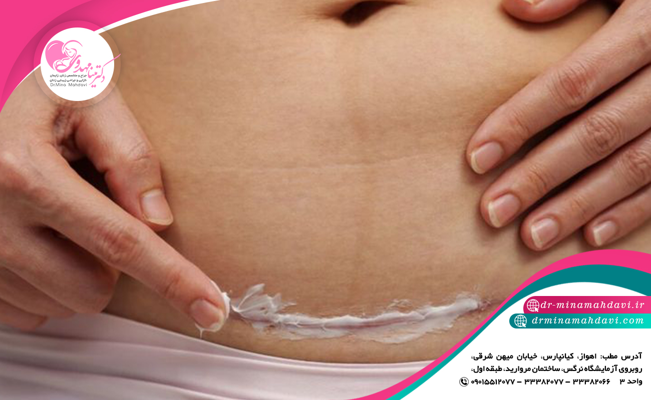 پیشگیری از باقیماندن جای بخیه سزارین