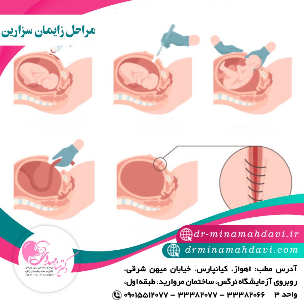 مراحل زایمان سزارین